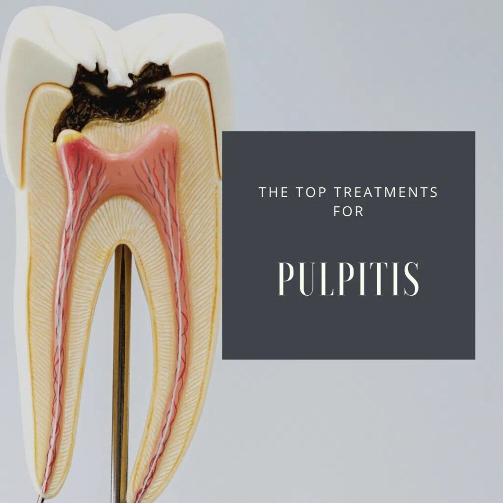 Pulpitis - dental model