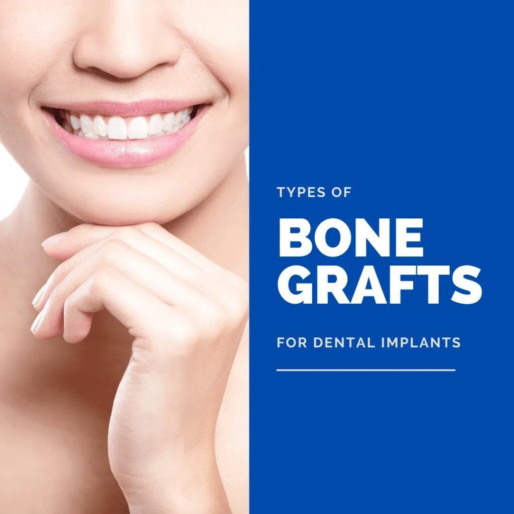 Woman after Bone Grafts for Dental Implants treatment