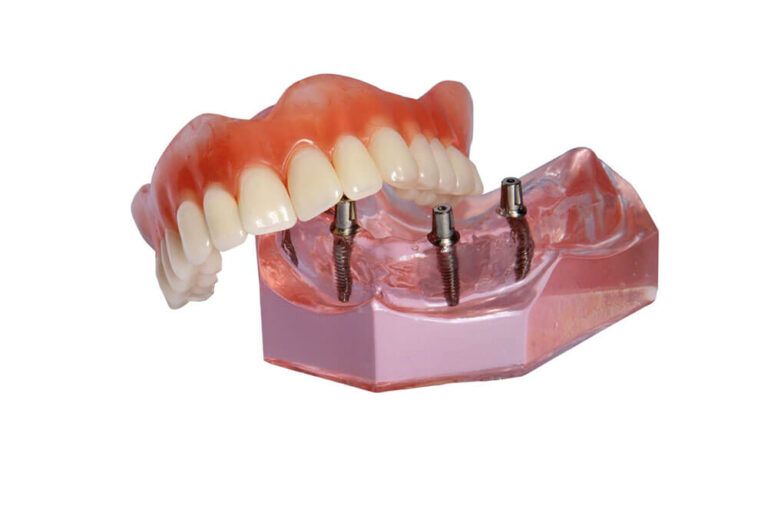Denture lies on model of top tooth jaw with implants