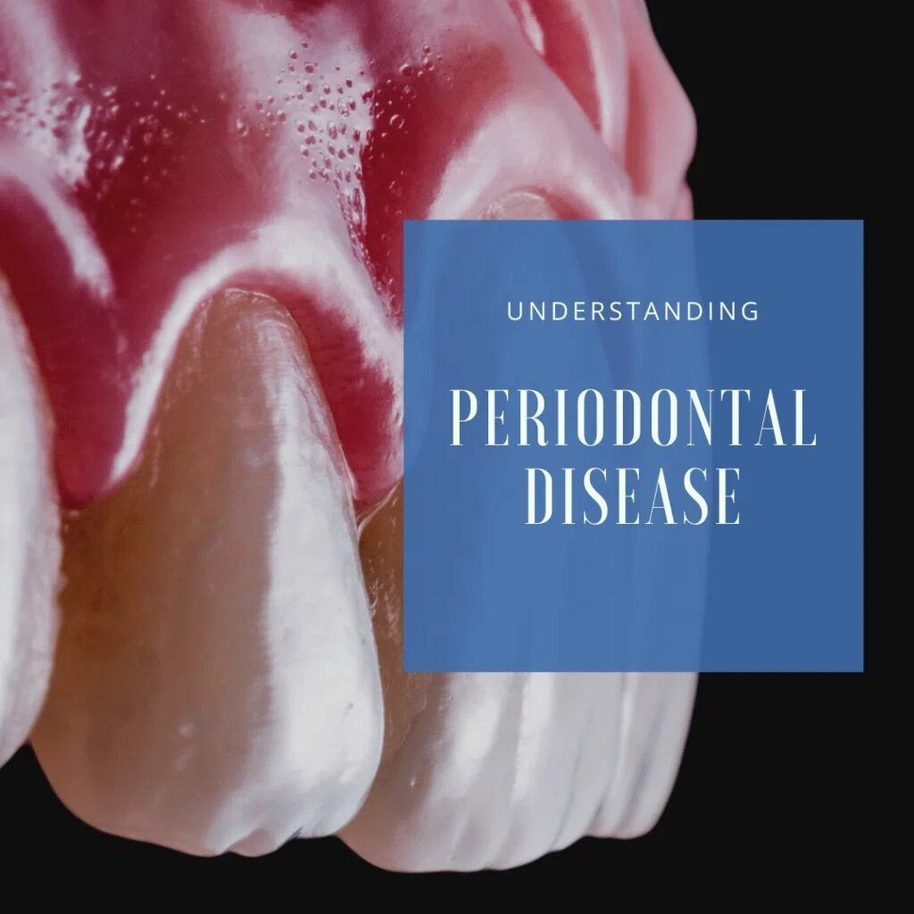 Periodontal Disease - dental model