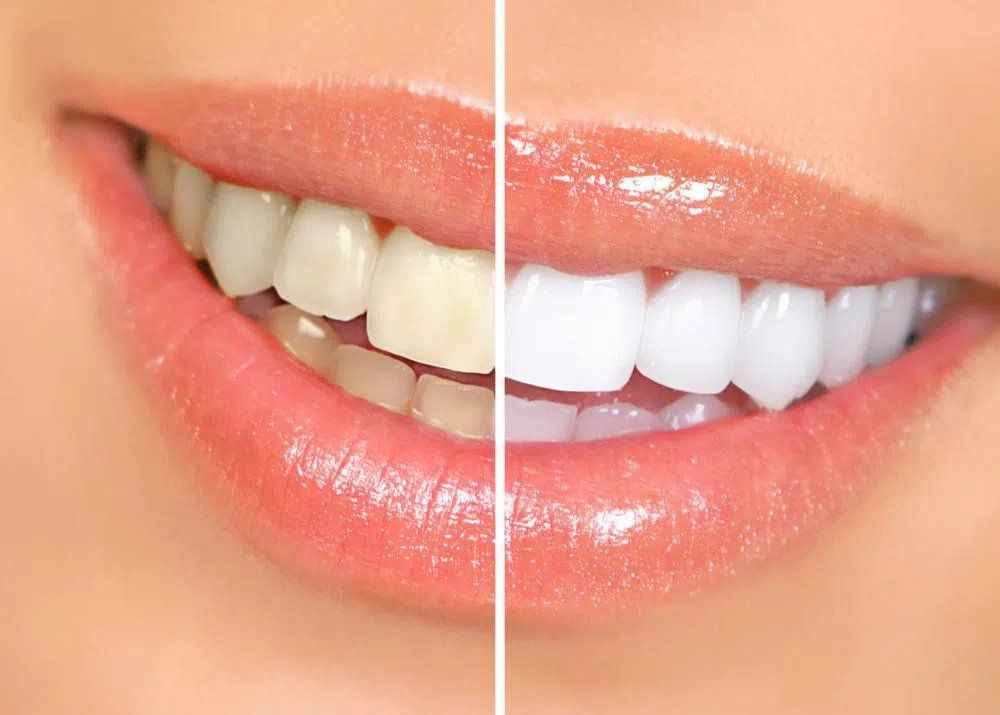 Teeth whitening Before and after image of a woman