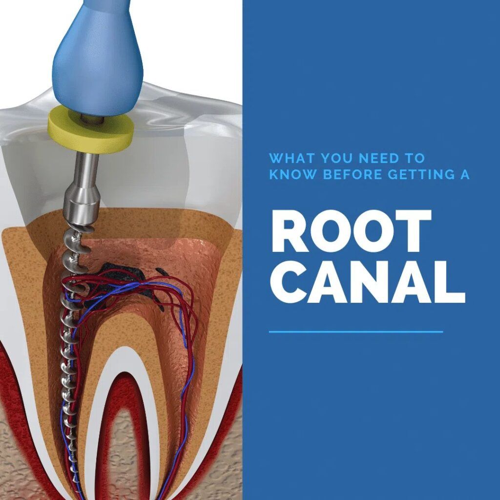 Root Canal treatment 3D image
