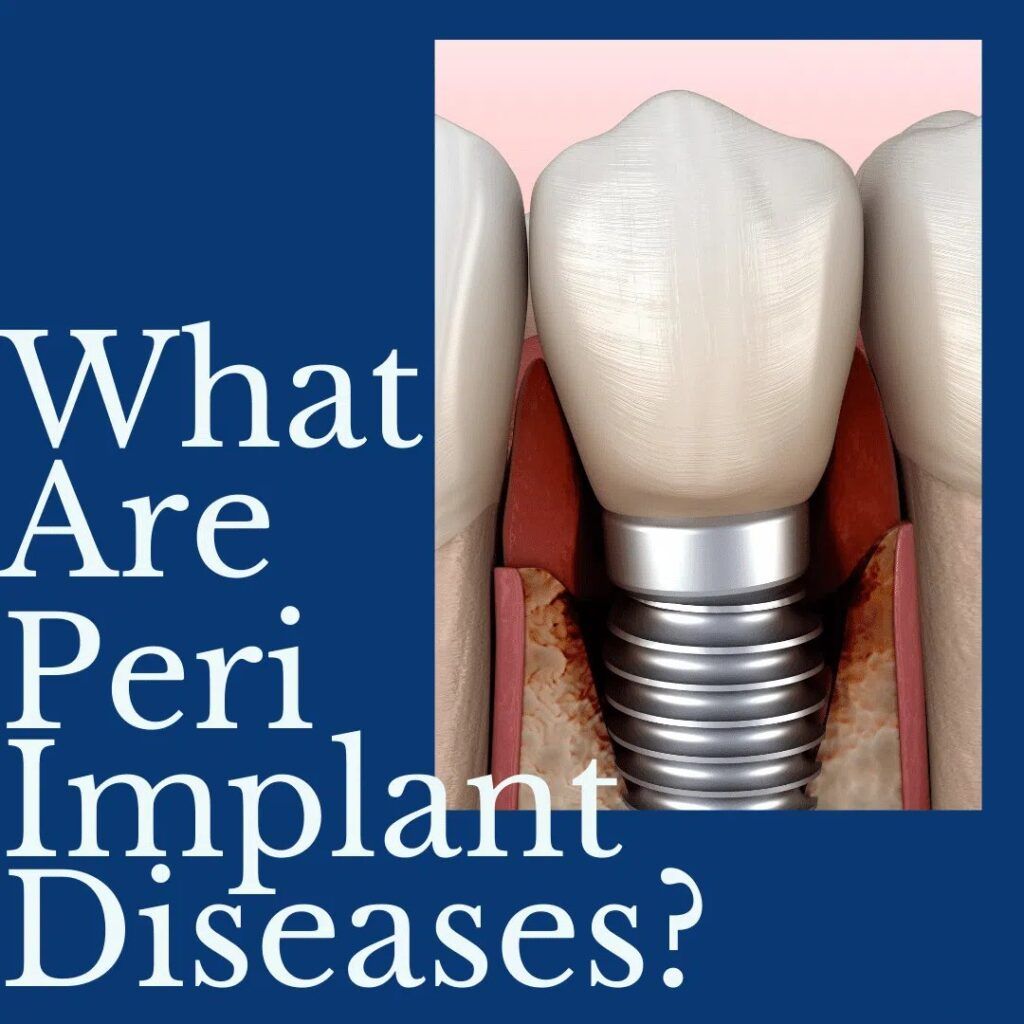 Dental Implants 3D image