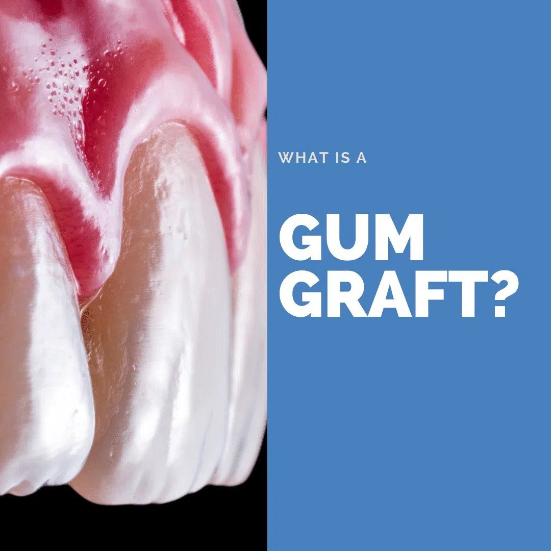 Gum Graft - dental model