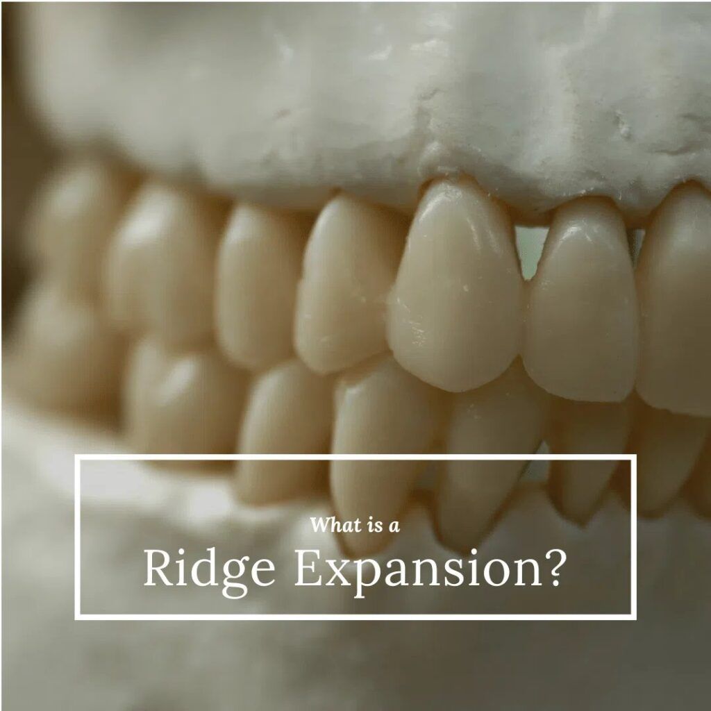 Ridge Expansion - dental model