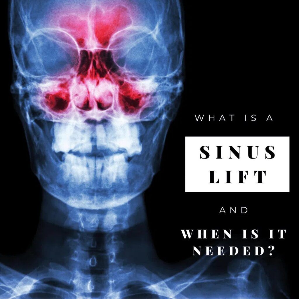 Sinus Lift model