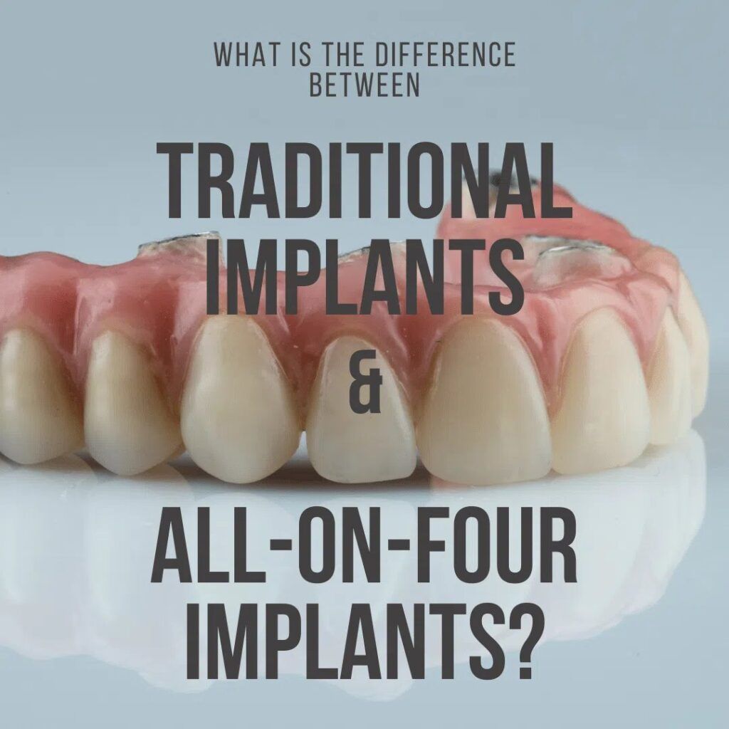 All-on-Four Implants