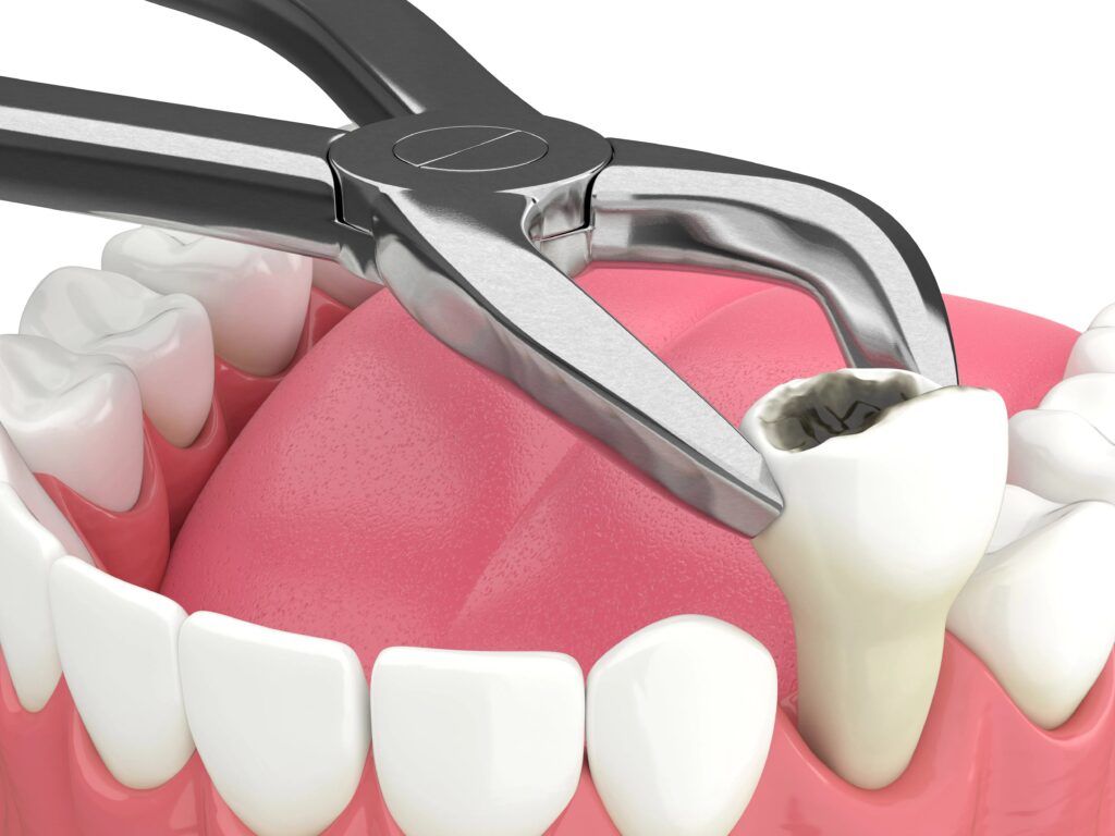 3d render of lower jaw with tooth extracted by dental forceps