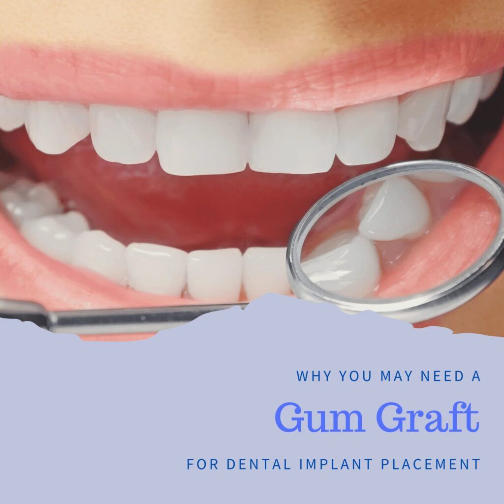 Gum Graft treatment
