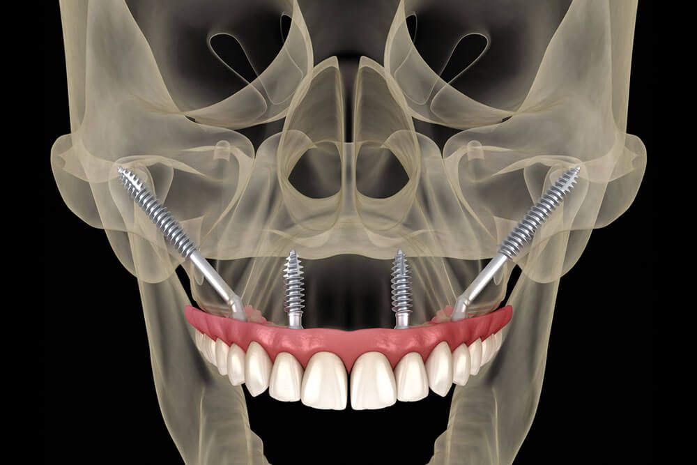 Maxillary prosthesis supported by zygomatic implants.