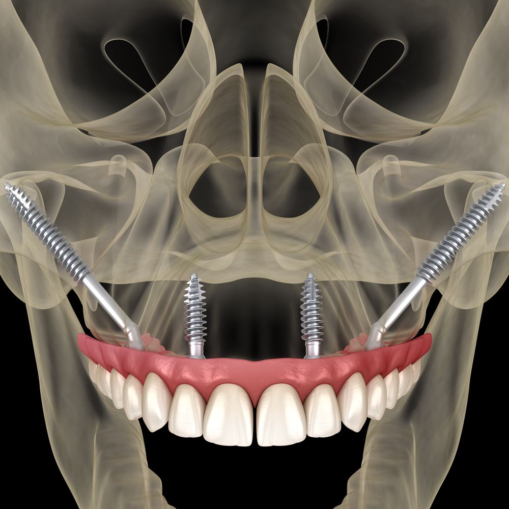 Maxillary prosthesis supported by zygomatic implants.