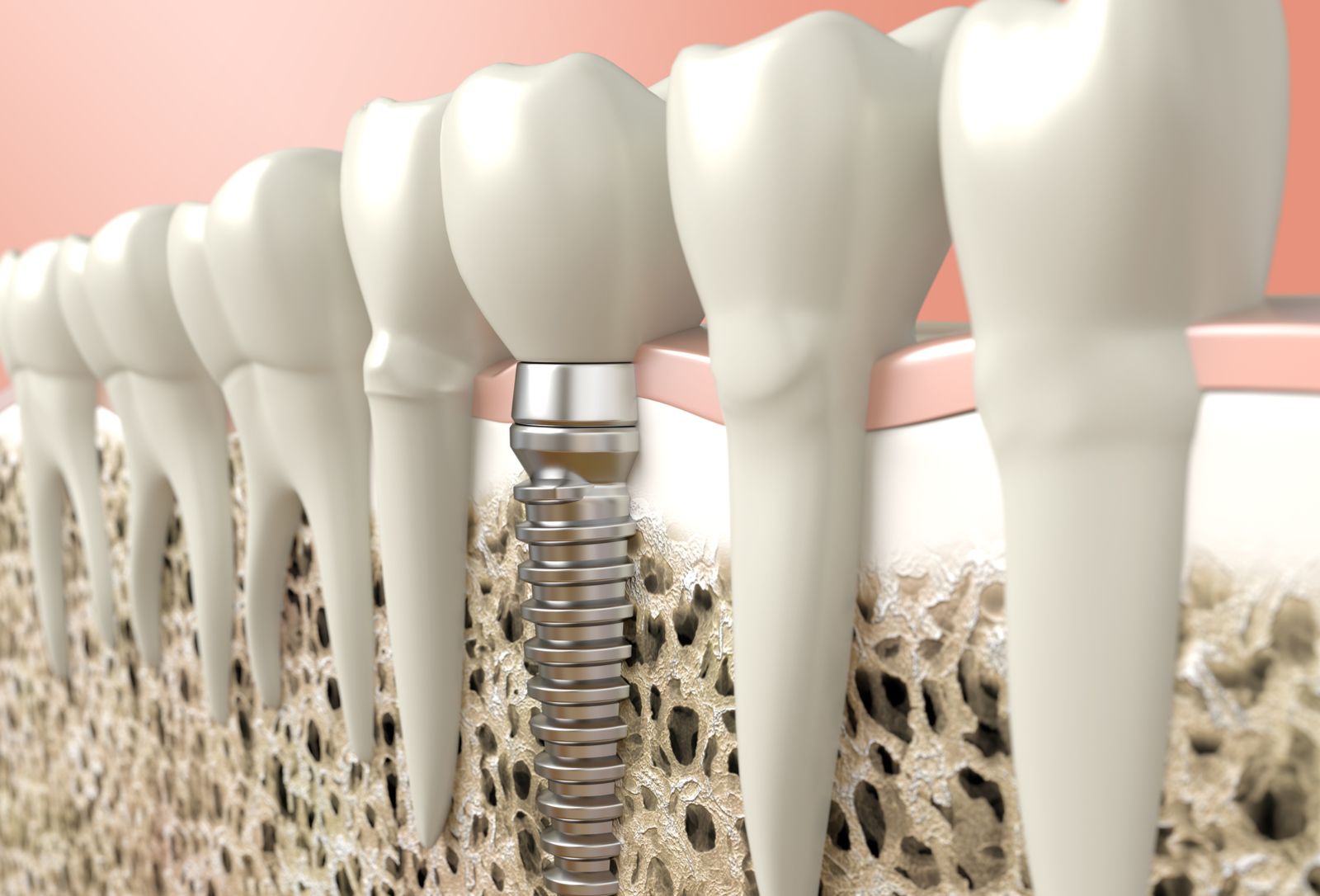 Dental implant 3D image