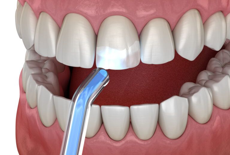 Tooth restoration with filling and polymerization lamp