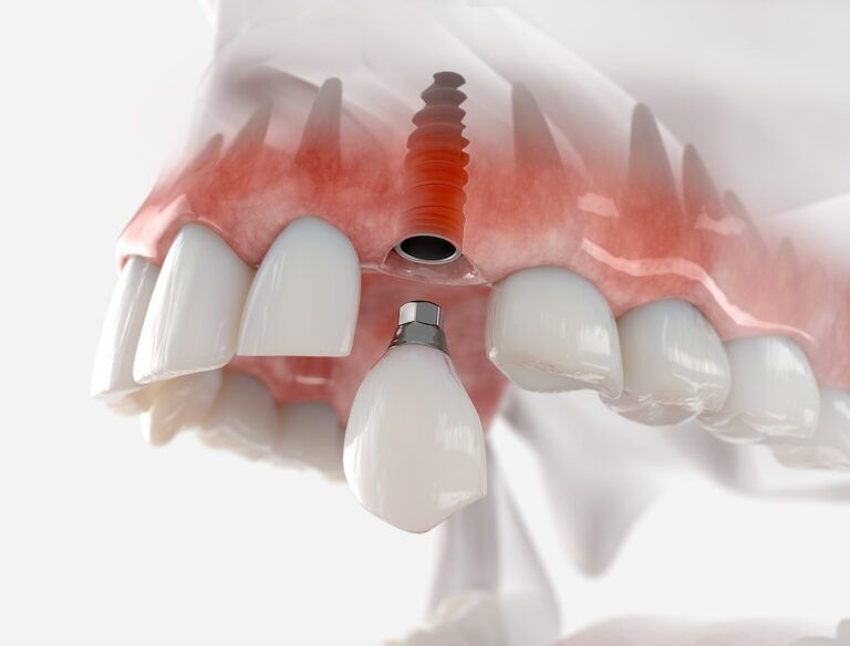 Replacement of maxillary canine with a dental implant