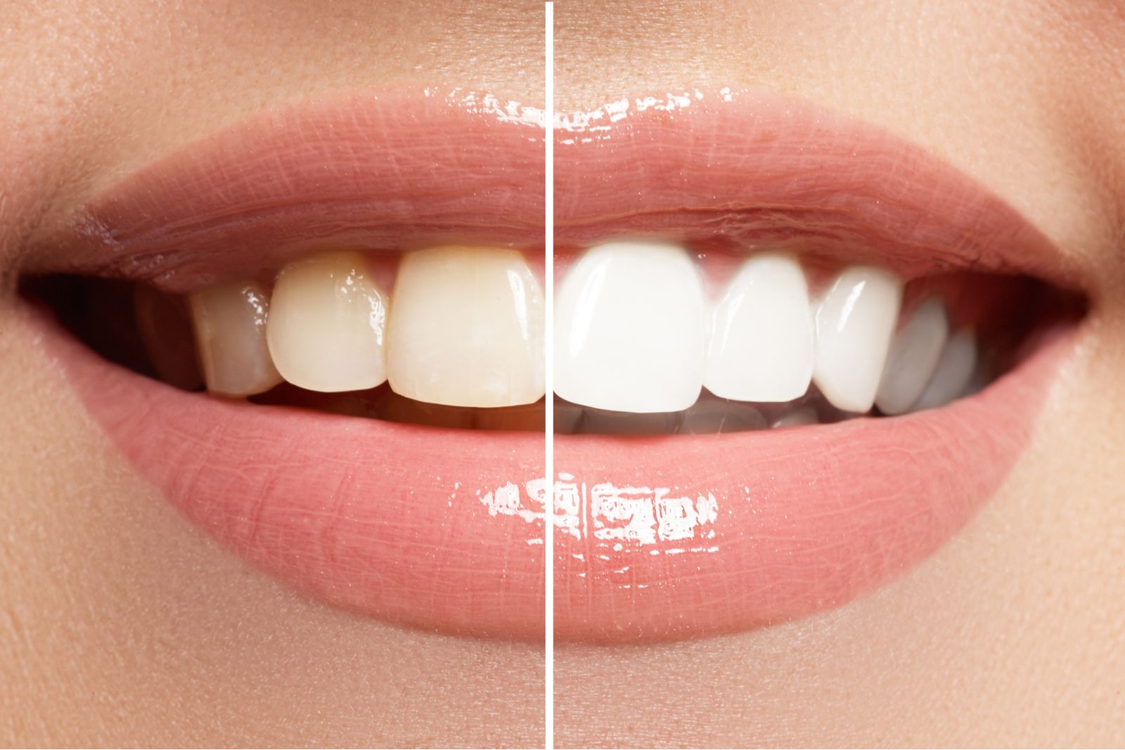 Perfect smile before and after bleaching