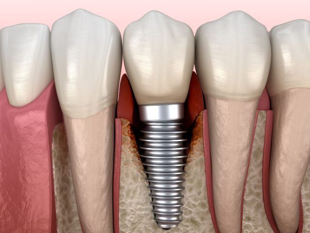 dental implant infection