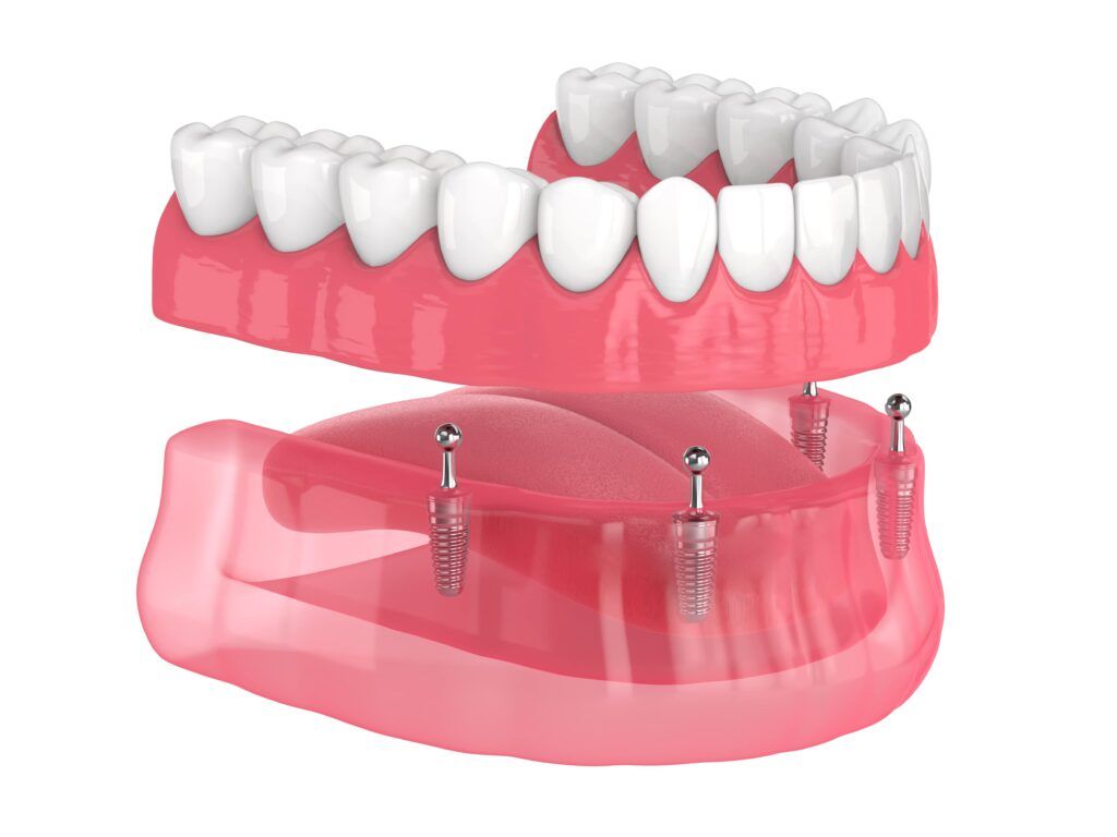 ball-retained implant supported denture. implant overdenture