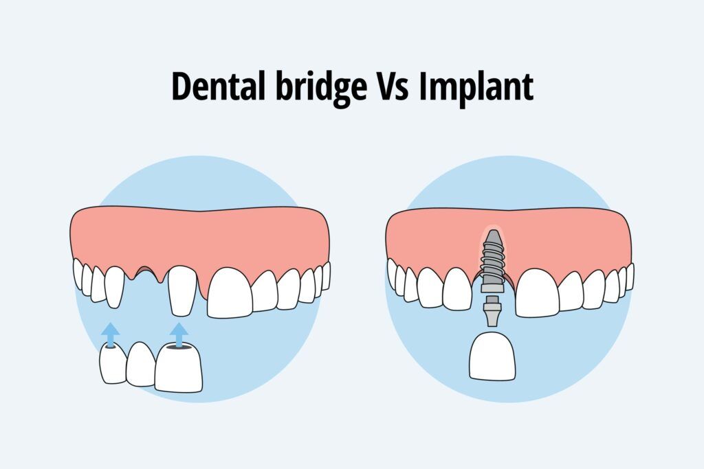 dental bridge vs dental implant