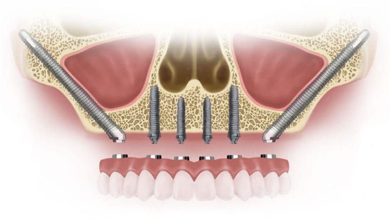 zygomatic implants