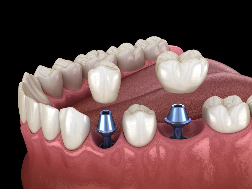 dental implant abutments