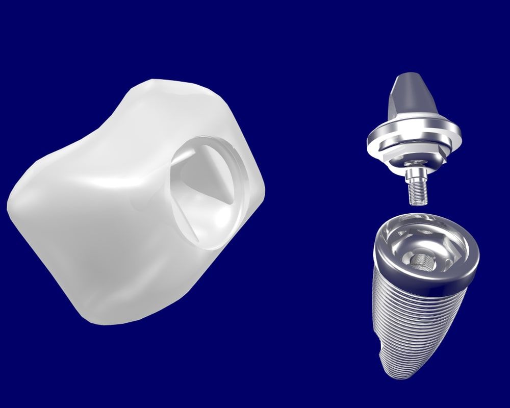 Different Types of Dental Abutments and Their Uses Chicago Dental