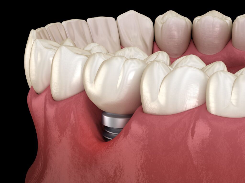 gum recession with dental implant showing
