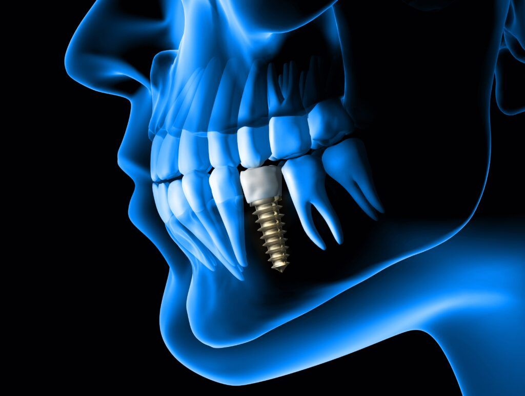 blue side profile of dental implant in jaw