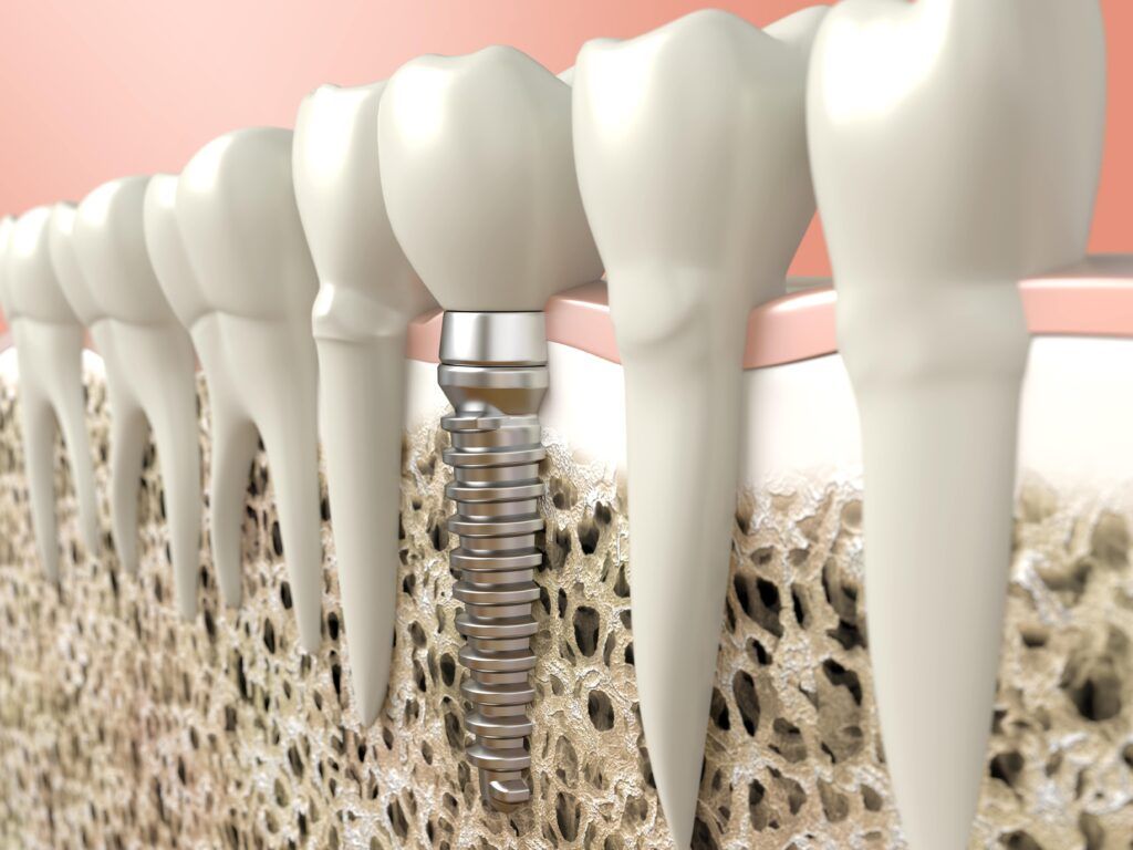 dental implant shown in jawbone beside natural teeth
