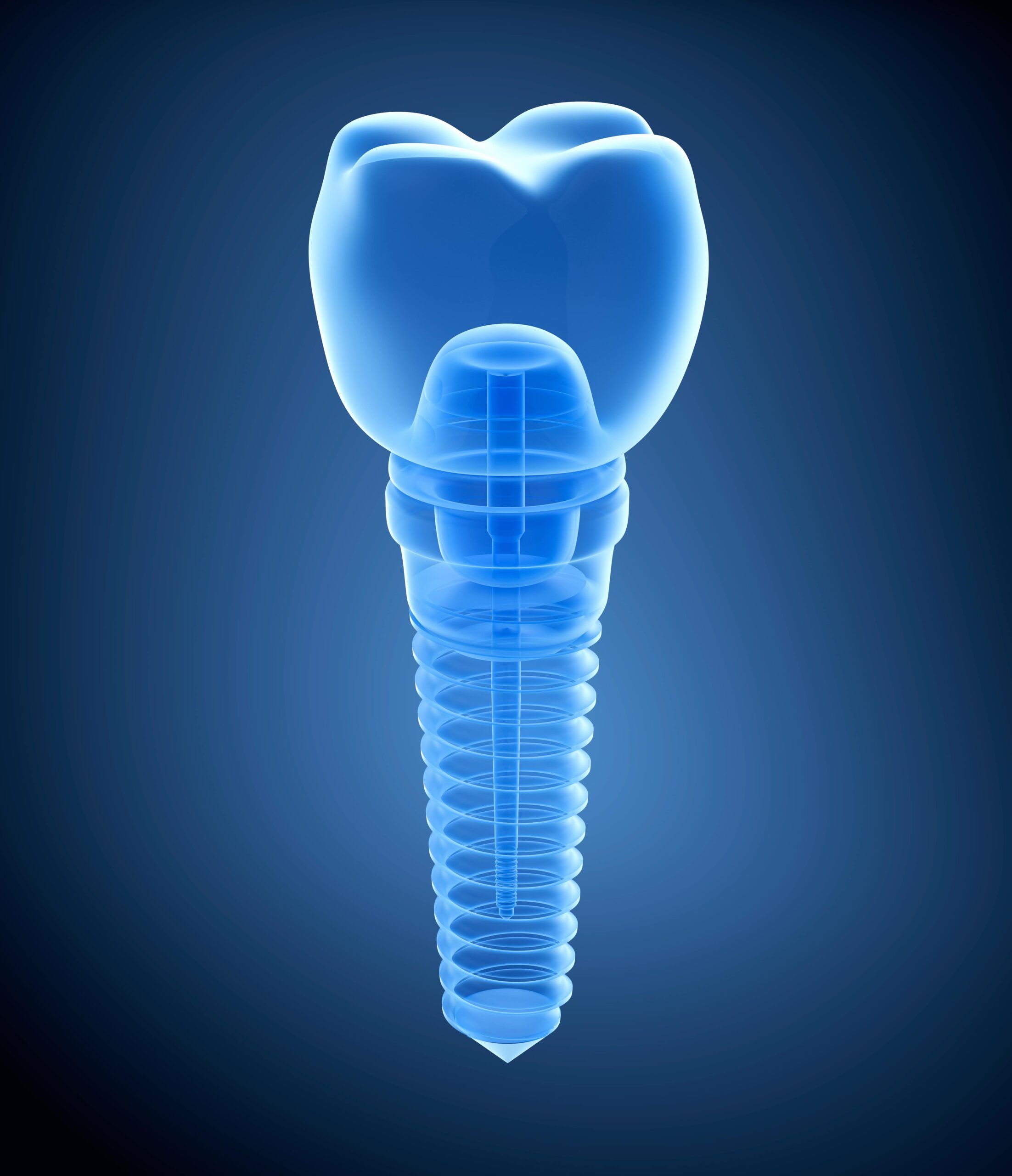 blue dental implant