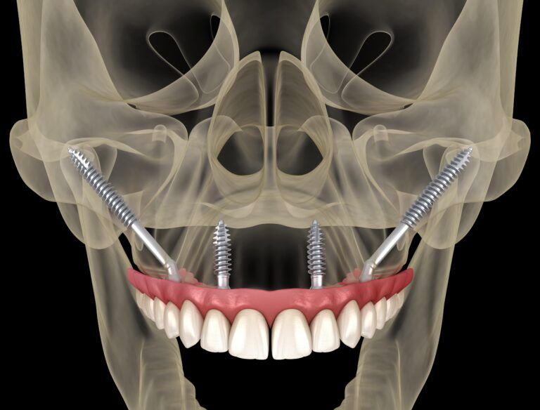 zygomatic implants shown in human skull