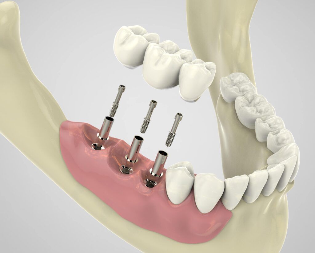 three dental implants in lower jaw