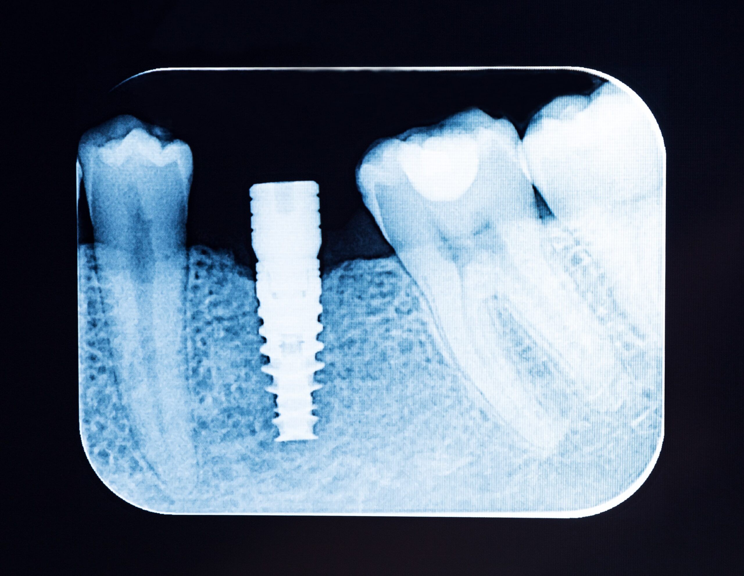 periapical dental x-ray with dental implant