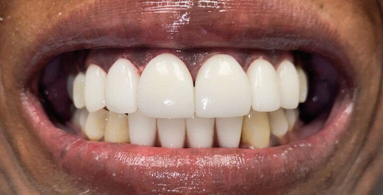 implant supported dentures