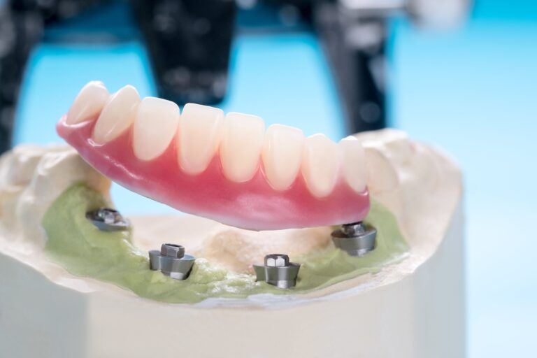 Closeup/ Dental implants supported overdenture on blue background/ Screw retained/ implant restorations.