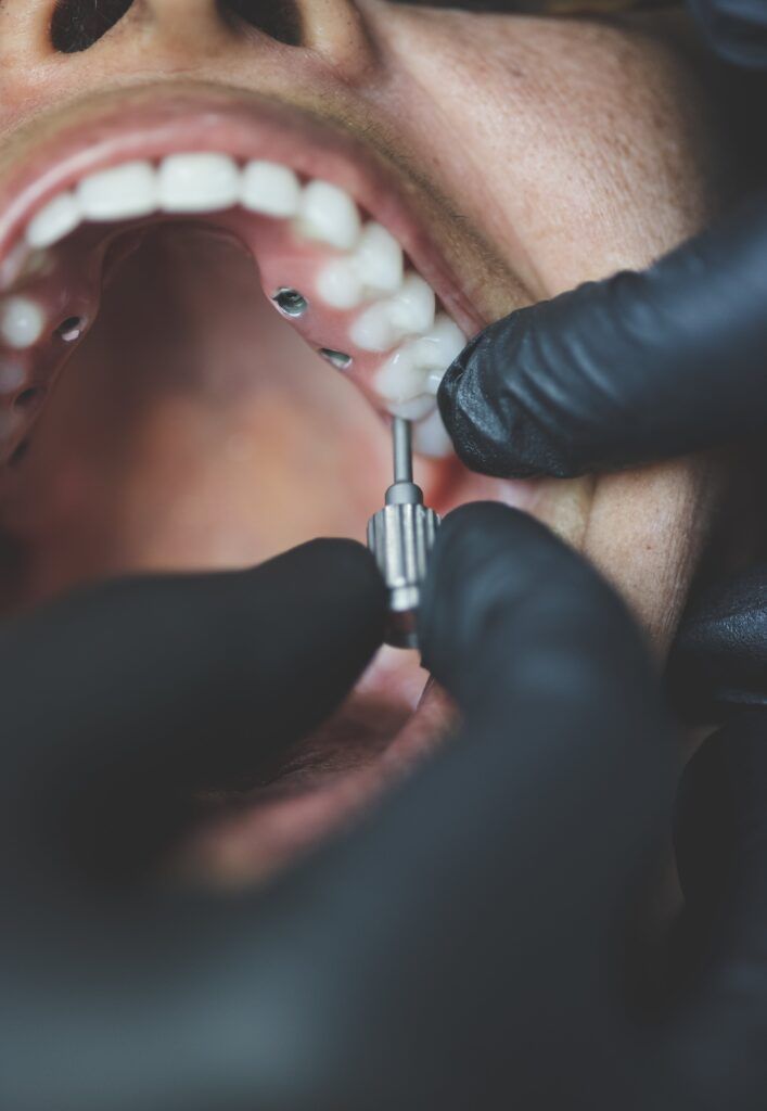 upper implant-supported denture being placed for full mouth reconstruction