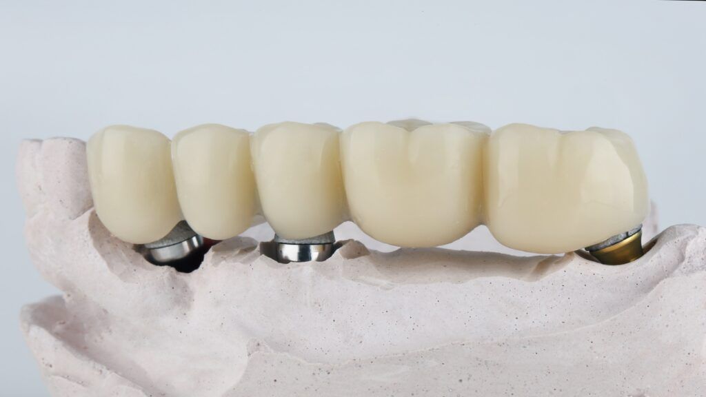 implant-supported dental bridge