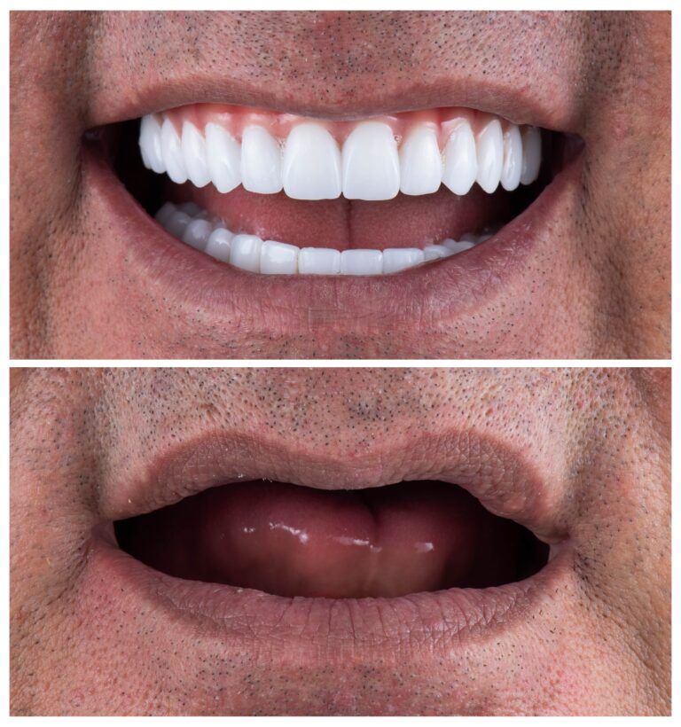 before and after full mouth reconstruction