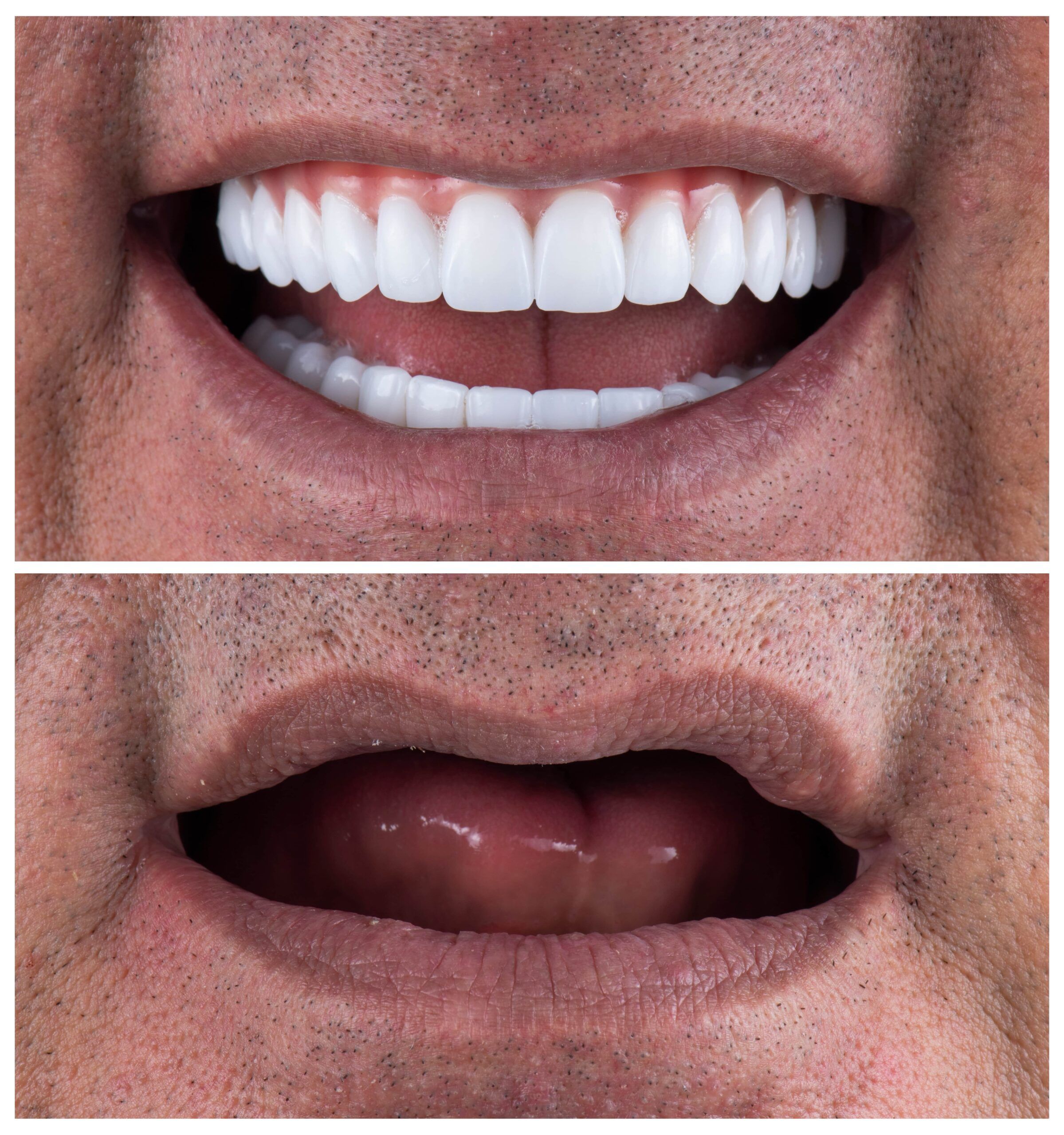 before and after full mouth reconstruction