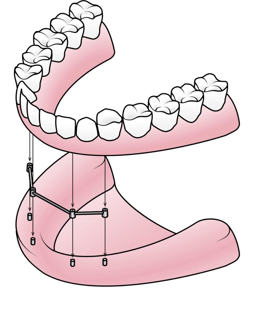 bar retained implant denture