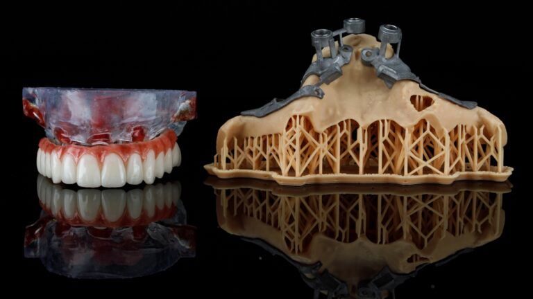 Zygomatic Implants
