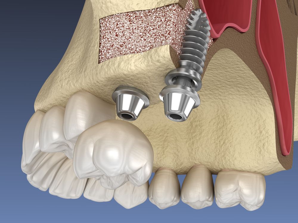 Sinus Lift Procedures: Elevating Success in Upper Jaw Implants