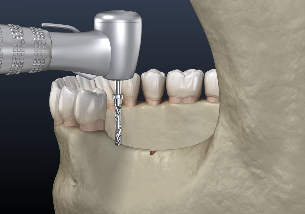 Ridge Augmentation: Rebuilding for Dental Implants