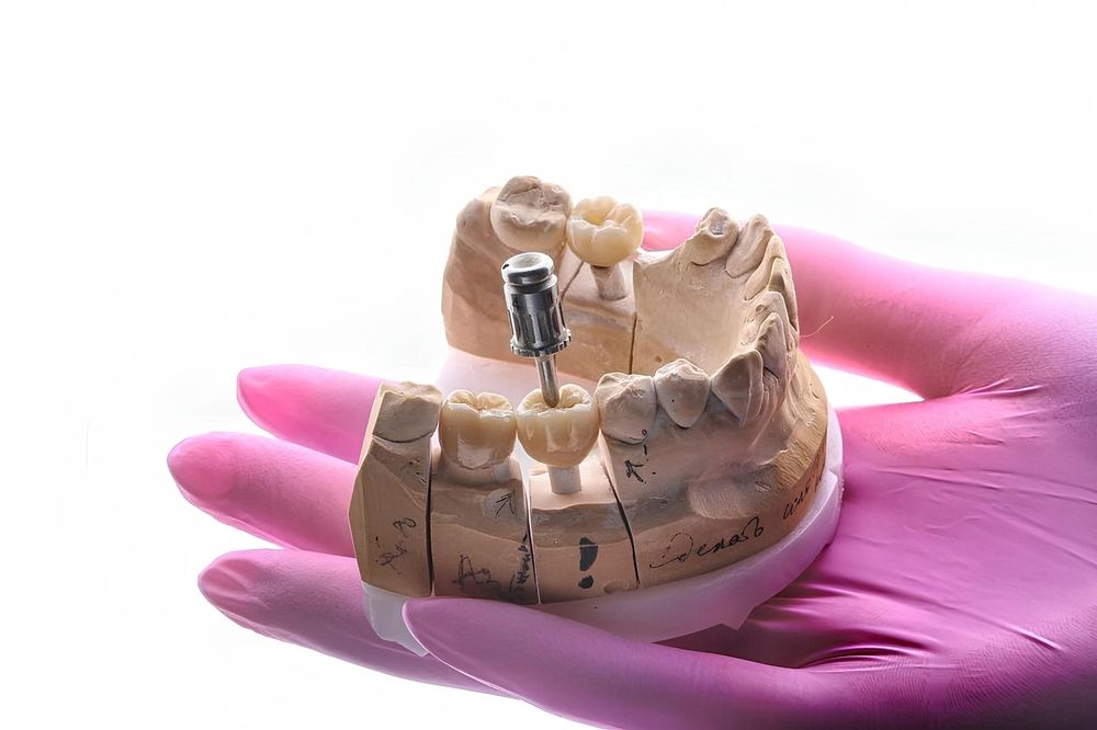 Bone Grafting: The Foundation for Successful Dental Implants