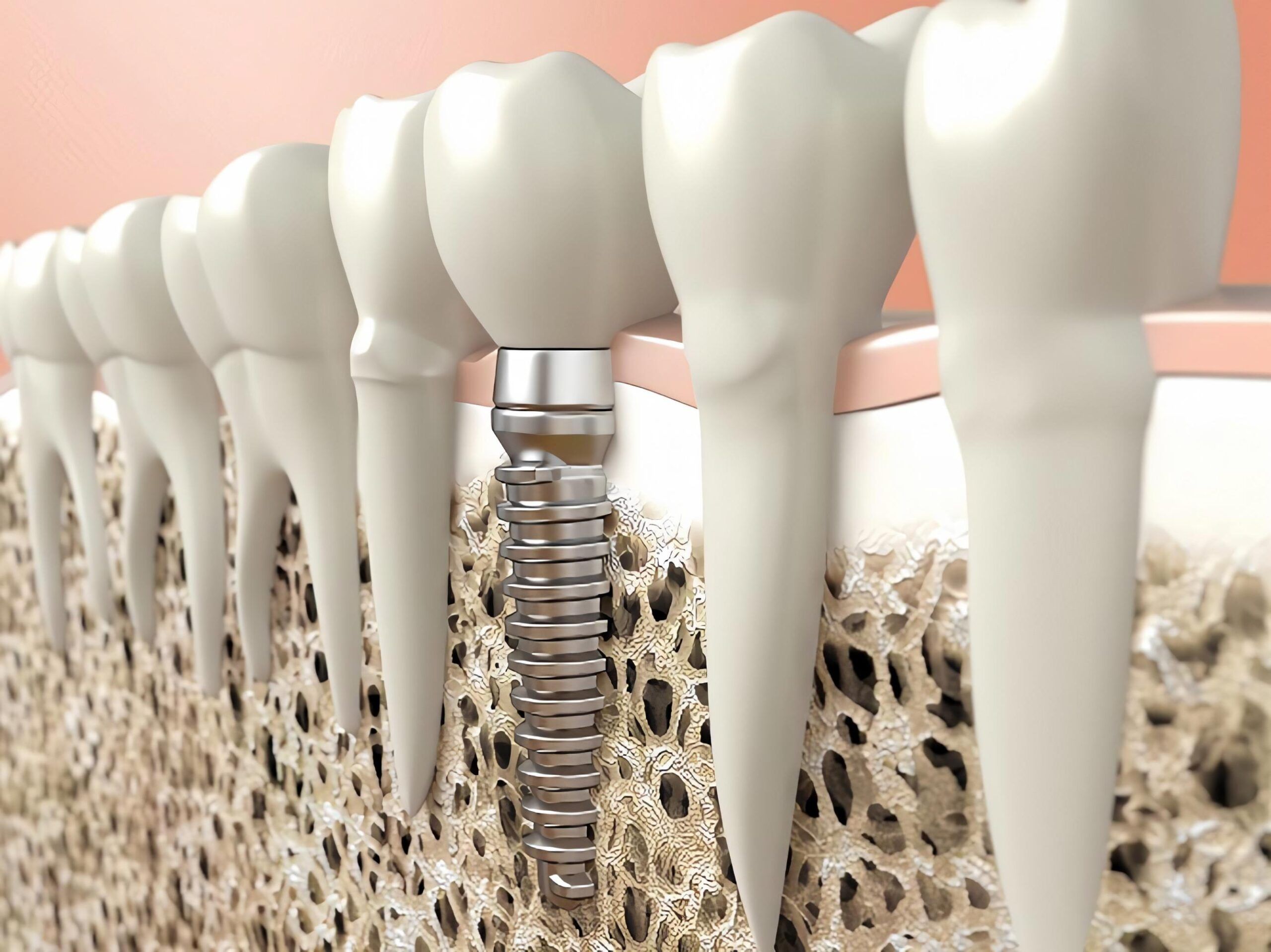 Getting Dental Implants with Osteoporosis: What You Need to Know