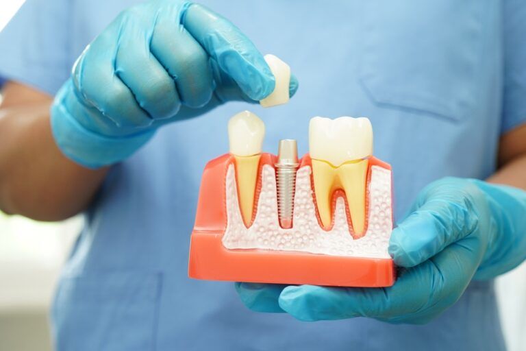 How Long Do Dental Implants Last? Debunking Common Misconceptions