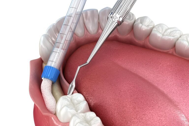 dental implants and bone grafting
