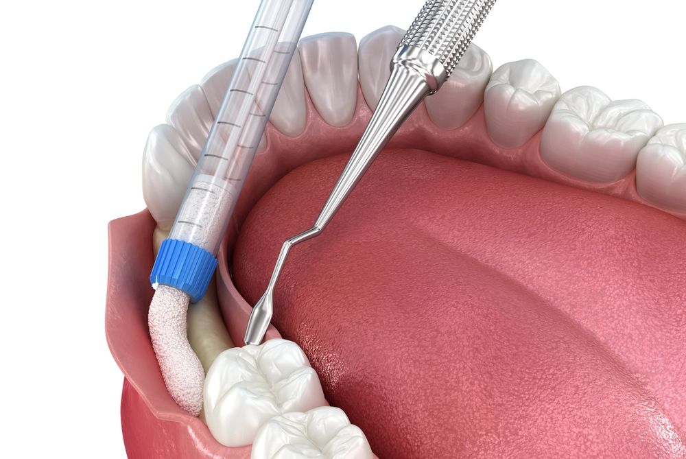 Bone,Grafting