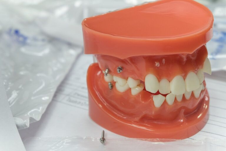 mini-implants in tooth model