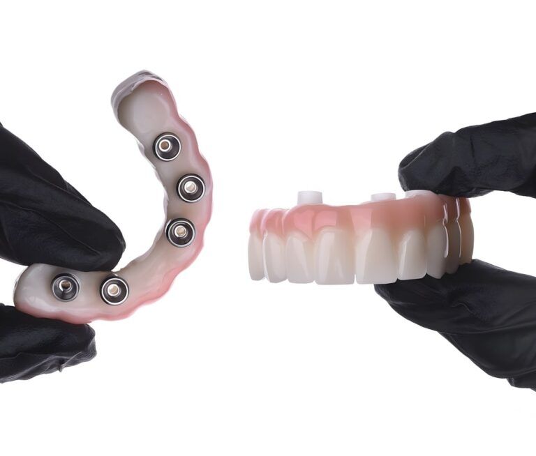 Dental implant treatment applied in completely edentulous jaws with dental jaw surgery