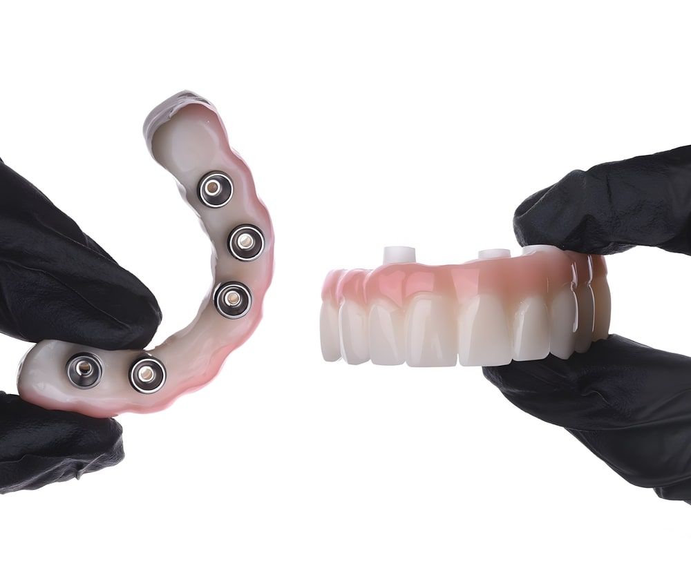 Dental implant treatment applied in completely edentulous jaws with dental jaw surgery